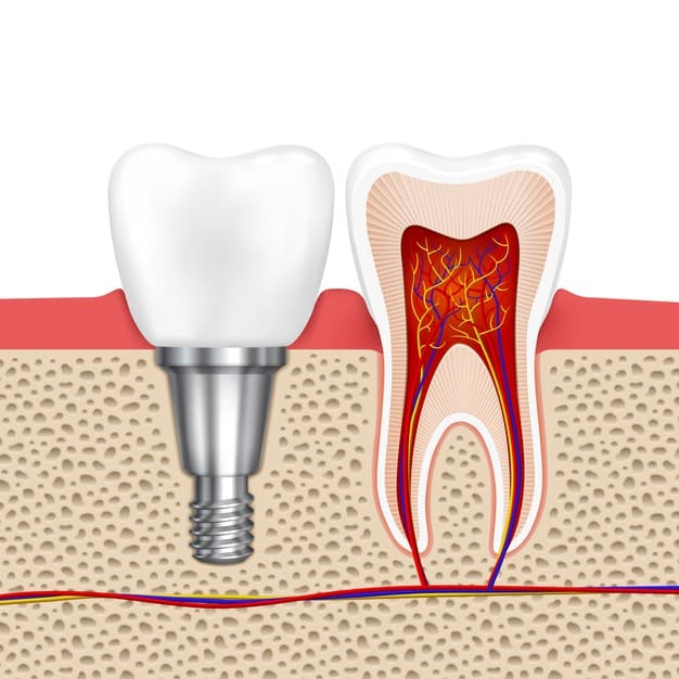 Dental Implant